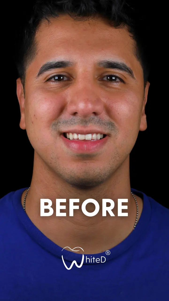 Antes del diseño de sonrisa con carillas en WhiteD · caso 1