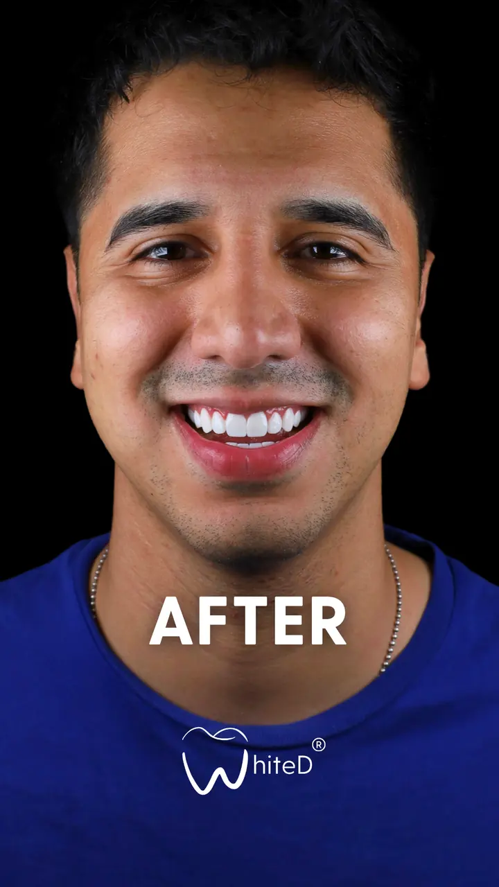Después del diseño de sonrisa con carillas en WhiteD · caso 1