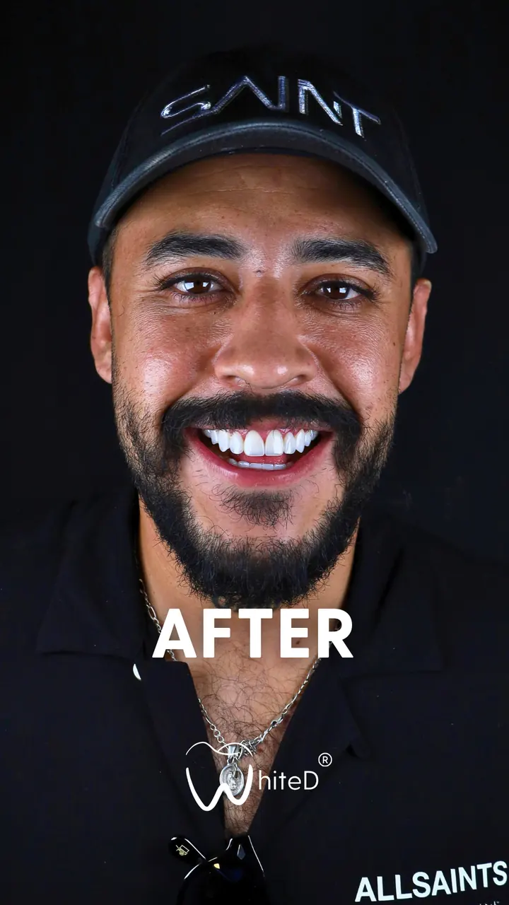 Después del diseño de sonrisa con carillas en WhiteD · caso 2