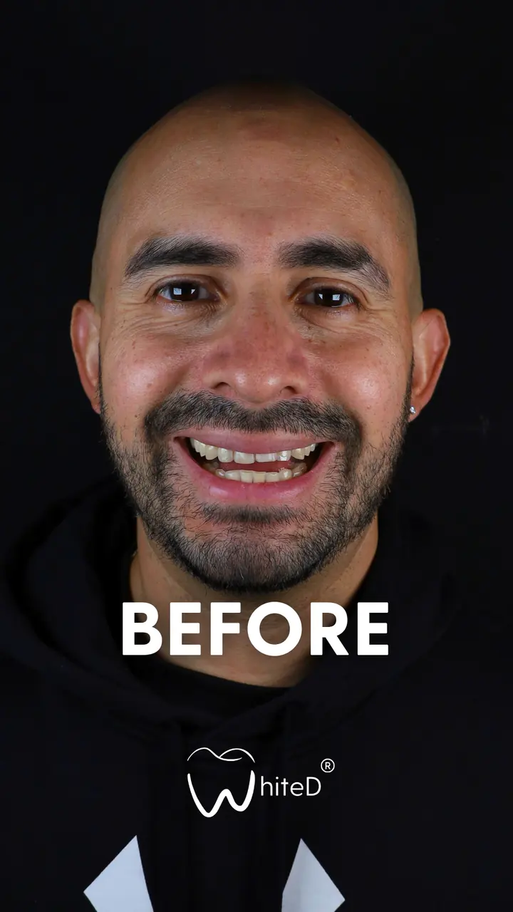 Antes del diseño de sonrisa con carillas en WhiteD · caso 3