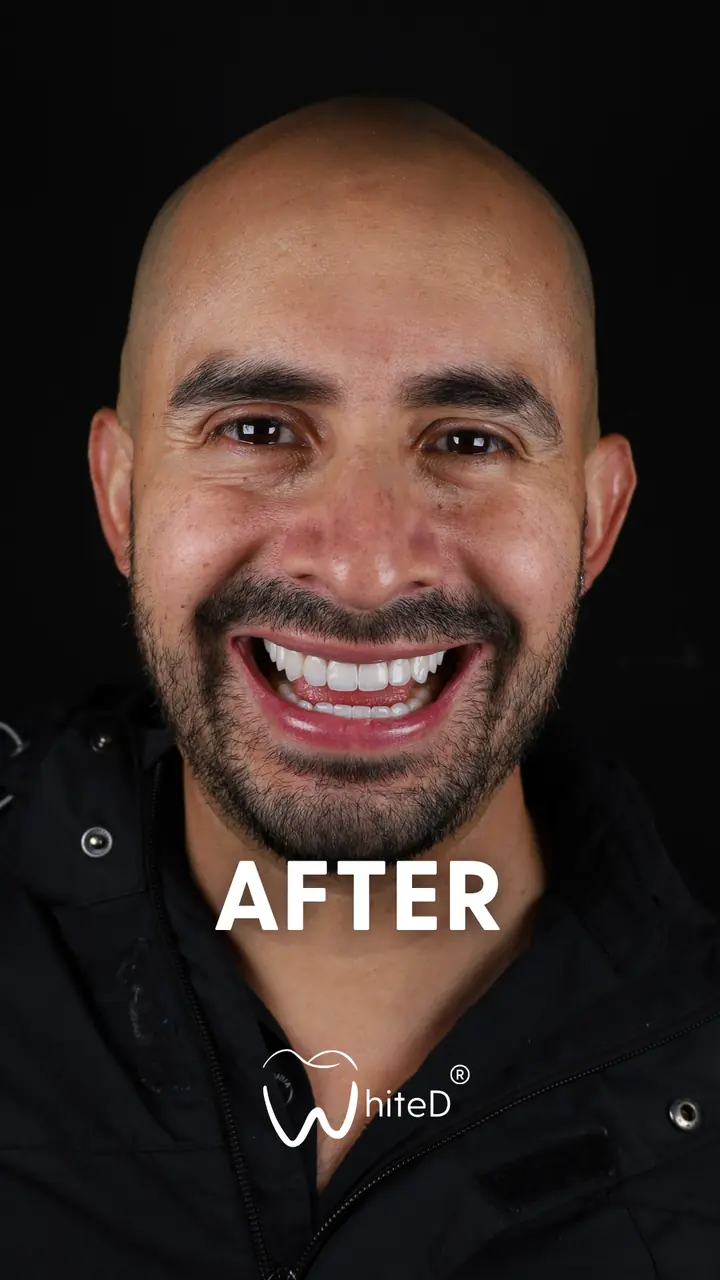 Después del diseño de sonrisa con carillas en WhiteD · caso 3