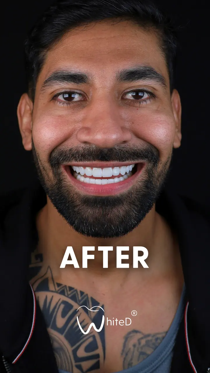 Después del diseño de sonrisa con carillas en WhiteD · caso 4