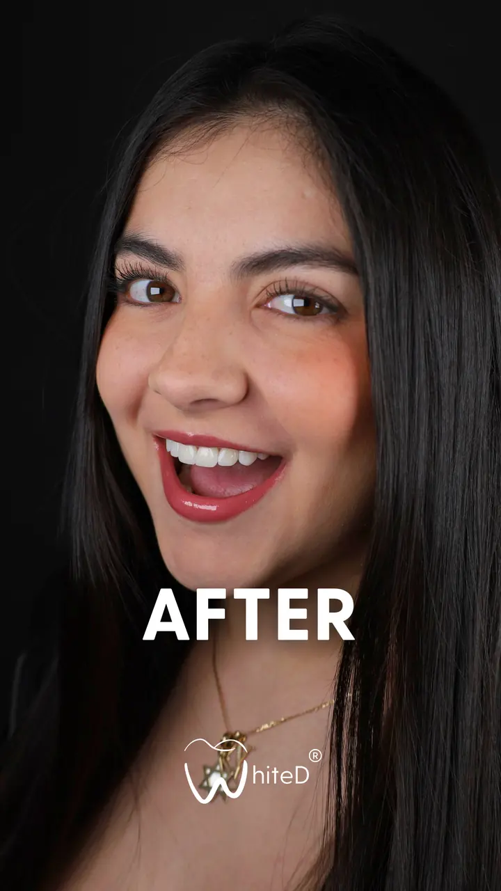 Después del diseño de sonrisa con carillas en WhiteD · caso 5