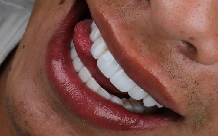 Diseño de sonrisa con carillas cerámicas EMAX en CDMX