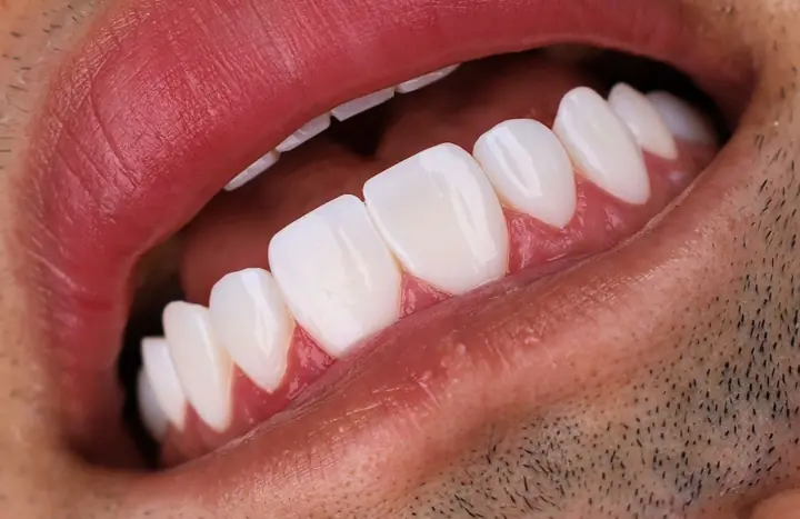 Diseño de sonrisa con carillas de resina monolíticas en CDMX